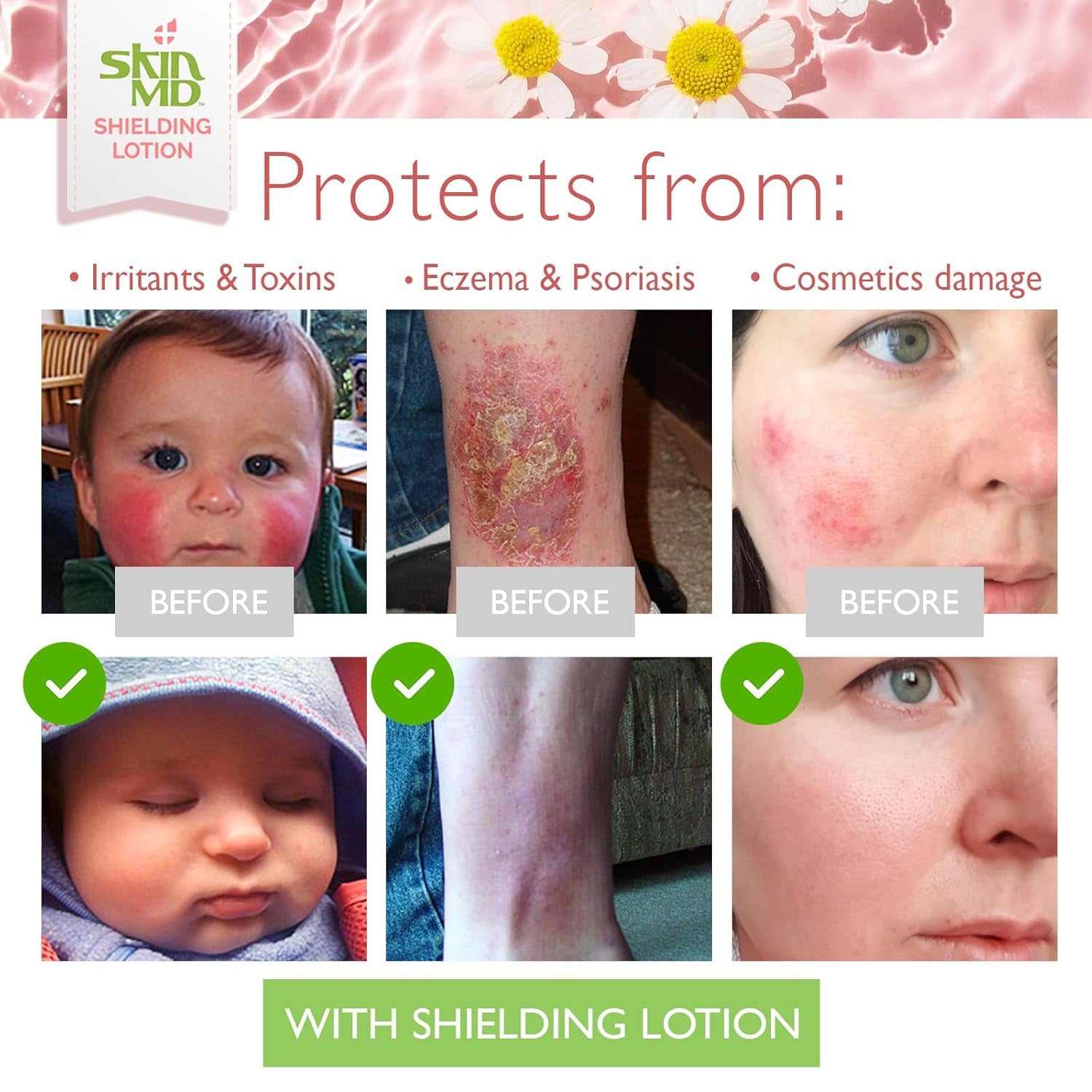 Skin MD Shielding Lotion for Face, Body & Hands 8Oz with Dispenser- Helps with Eczema & Psoriasis! the Natural Dry Skin Remedy to the Things That Dry Your Skin