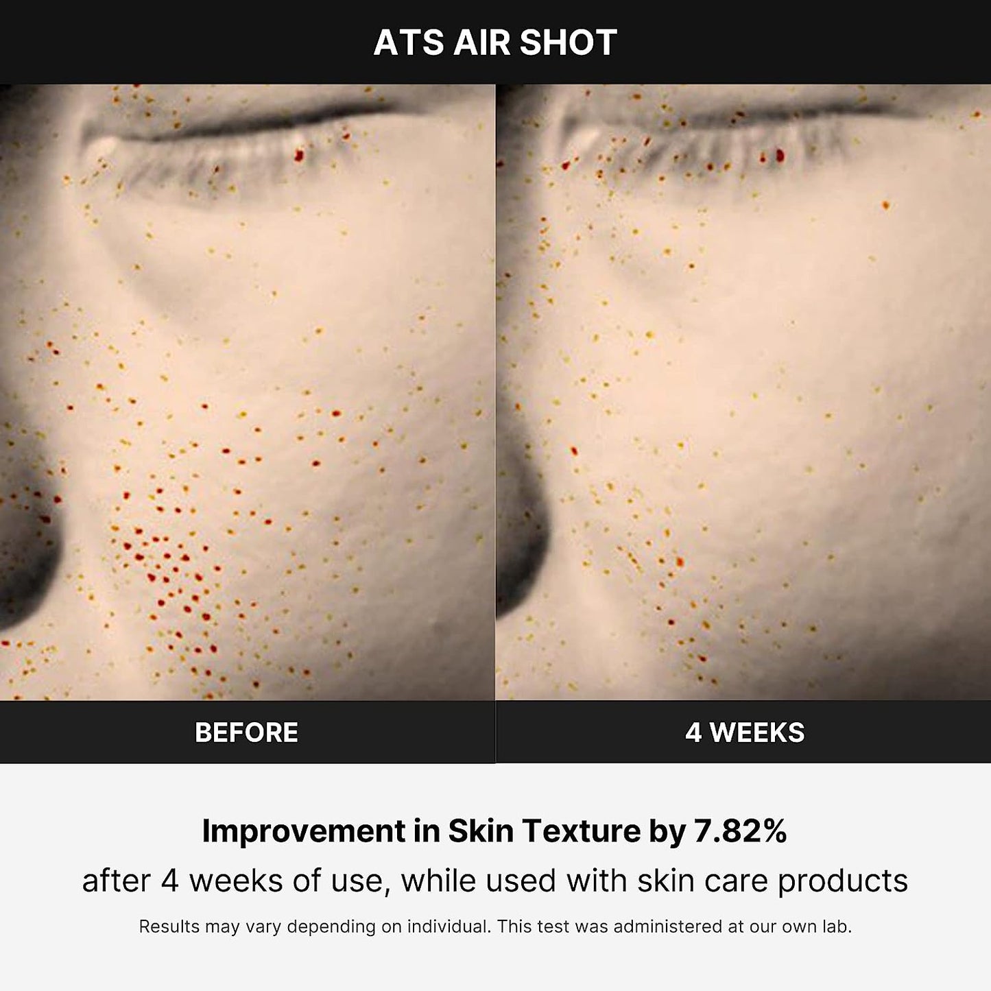 Age-R ATS Air Shot - Microneedling Skin Care Device for Pore Tightening, Enhanced Absorption, and Smoother Skin Texture - Exfoliation and Skin Rejuvenation - Korean Skincare